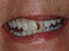 02.1Anne-L-fall-broke-tooth