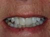 02.2-Anne-L-fall-broke-tooth