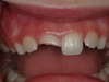 broken-tooth-repaired-with-composite-01