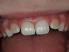 broken-tooth-repaired-with-composite-02