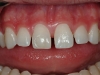 closing-gaps-between-teeth-01