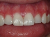 closing-gaps-between-teeth-02
