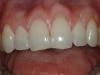 recontour-of-pointy-canines-and-uneven-edges-01