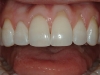 recontour-of-pointy-canines-and-uneven-edges-02