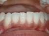 recontouring-chips-in-enamel-01
