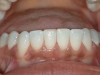 recontouring-chips-in-enamel-02