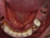 replacement-of-missing-teeth-with-implants-and-crowns-01