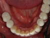 replacement-of-missing-teeth-with-implants-and-crowns-02