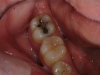replacing-old-amalgam-with-composite-01