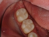 replacing-old-amalgam-with-composite-02